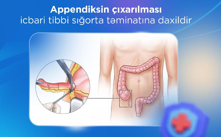 Appendiksin çıxarılması icbari tibbi sığorta təminatına daxildir 