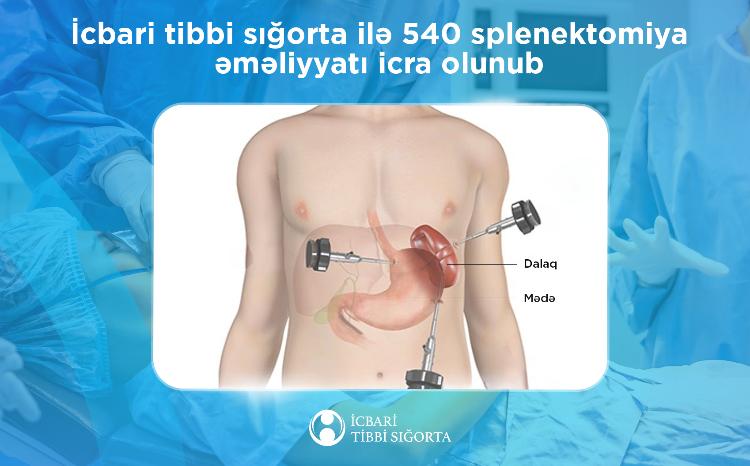 İcbari tibbi sığorta ilə 540 splenektomiya əməliyyatı icra olunub 