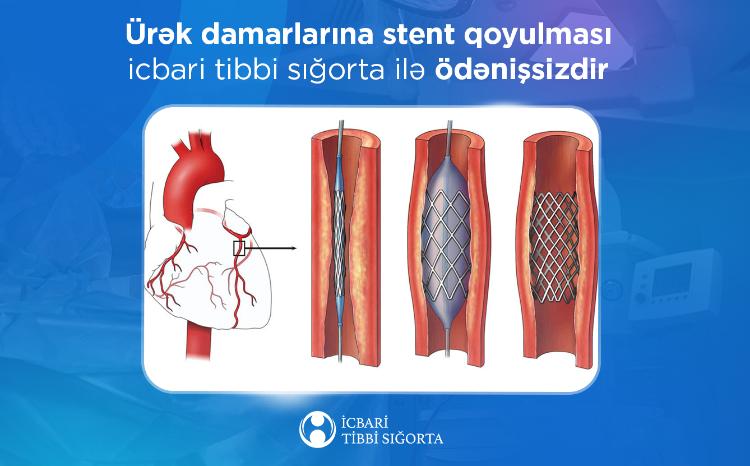 Ürək damarlarına stent qoyulması icbari tibbi sığorta ilə ödənişsizdir 