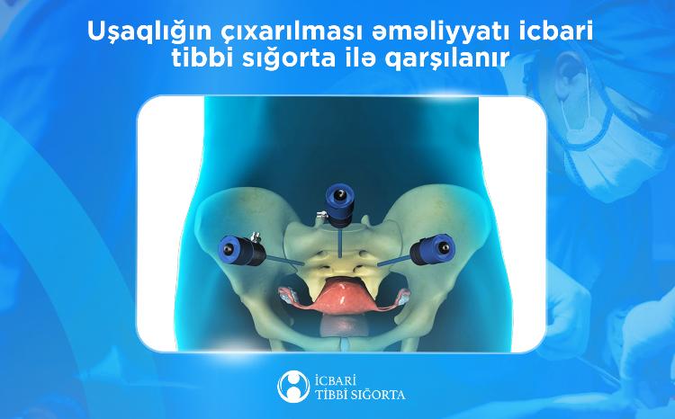 İcbari tibbi sığorta uşaqlığın çıxarılması əməliyyatını qarşılayır 