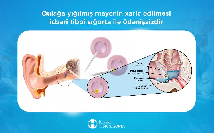Kəskin orta otitin cərrahi müalicəsi icbari tibbi sığorta ilə qarşılanır 