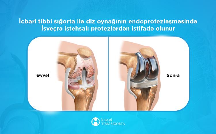 Diz oynağının endoprotezləşməsində İsveçrə istehsalı protezlərdən istifadə olunur 