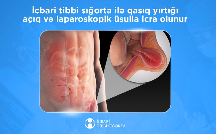 İcbari tibbi sığorta ilə qasıq yırtığı açıq və laparoskopik üsulla icra olunur 