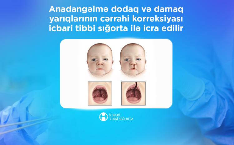 Anadangəlmə dodaq və damaq yarıqlarının cərrahi korreksiyası icbari tibbi sığorta ilə icra edilir 