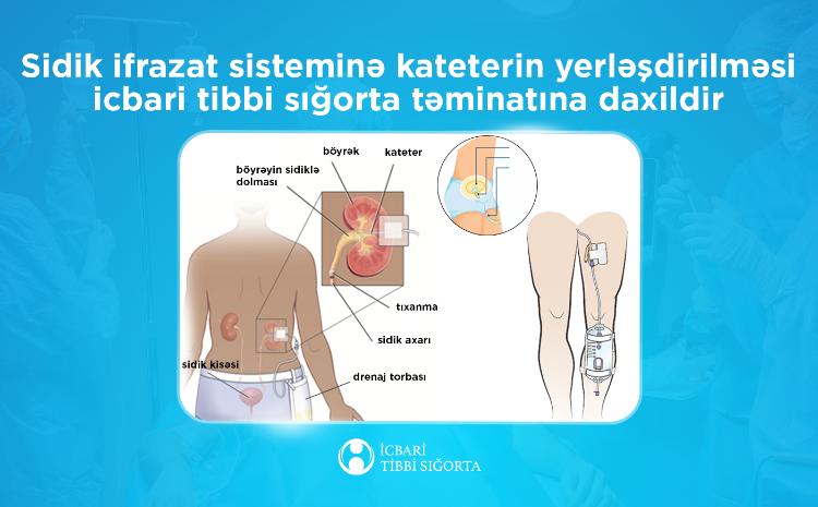 Sidik-ifrazat sisteminin katerizasiyası icbari tibbi sığorta təminatına daxildir 