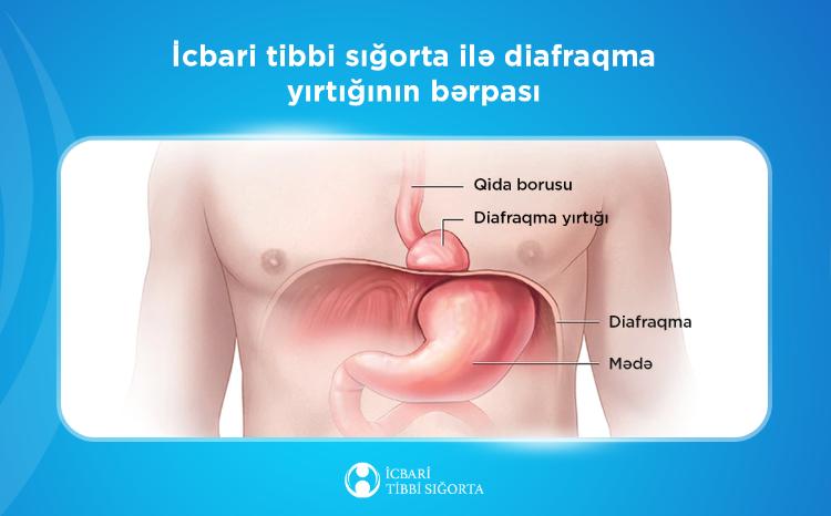Diafraqmal yırtıqların bərpası icbari tibbi sığorta təminatına daxildir 