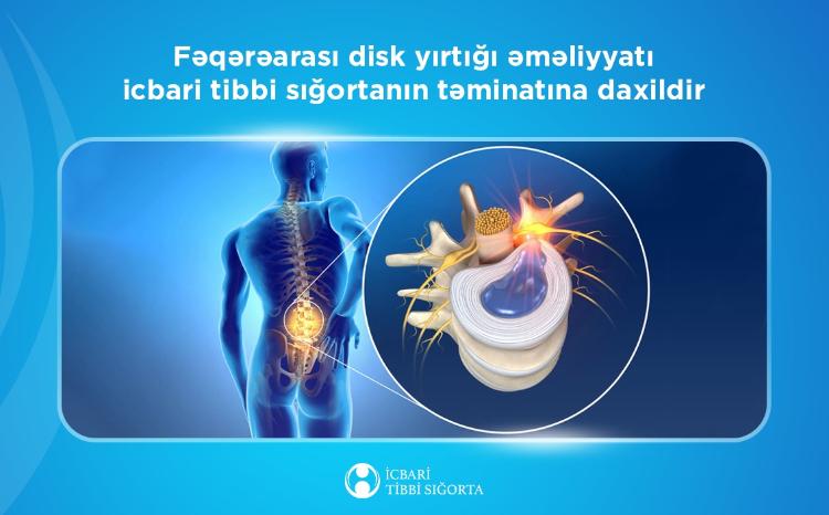 Fəqərəarası disk yırtığı əməliyyatı icbari tibbi sığortanın təminatına daxildir 