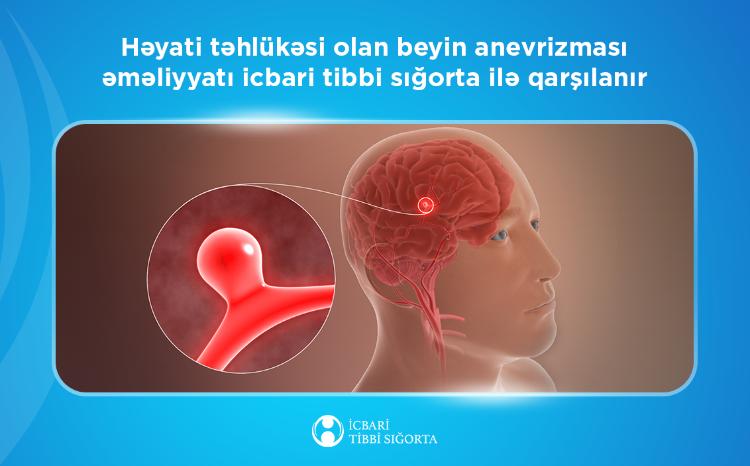 Həyati təhlükəsi olan beyin anevrizması əməliyyatı icbari tibbi sığorta ilə qarşılanır 