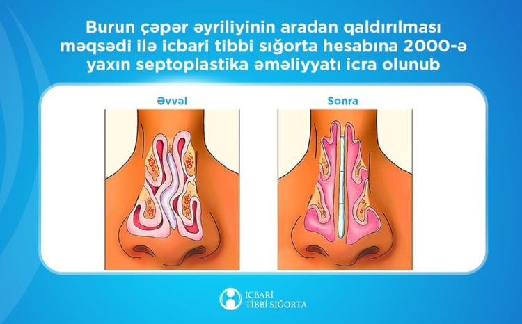 İcbari tibbi sığorta ilə 2000-ə yaxın burun çəpəri əməliyyatı icra olunub 