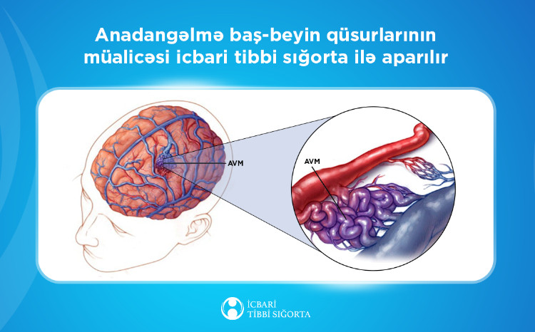 Anadangəlmə baş-beyin qüsurlarının açıq üsulla əməliyyatı icbari tibbi sığorta ilə icra olunur 
