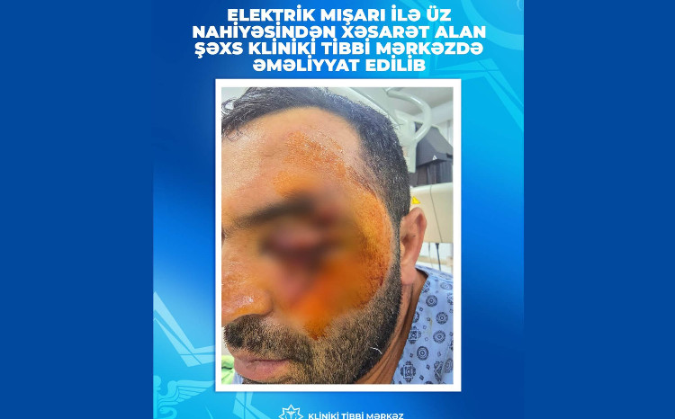Üzünü elektrik mişarı ilə kəsmişdi, əməliyyat edildi 