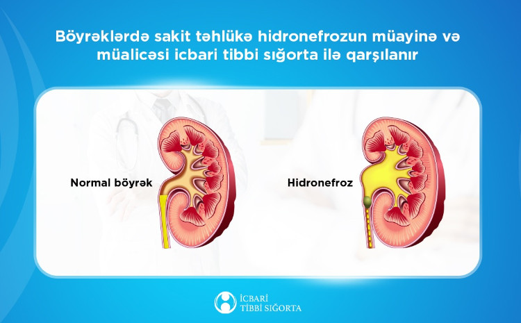 Böyrəklərdə sakit təhlükə - hidronefrozun müayinə və müalicəsi icbari tibbi sığorta ilə qarşılanır 